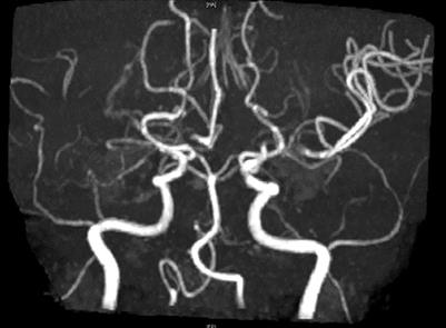 Case report: Steroid-responsive acute chorea as first presentation of the coexistence of Moyamoya and Graves' disease